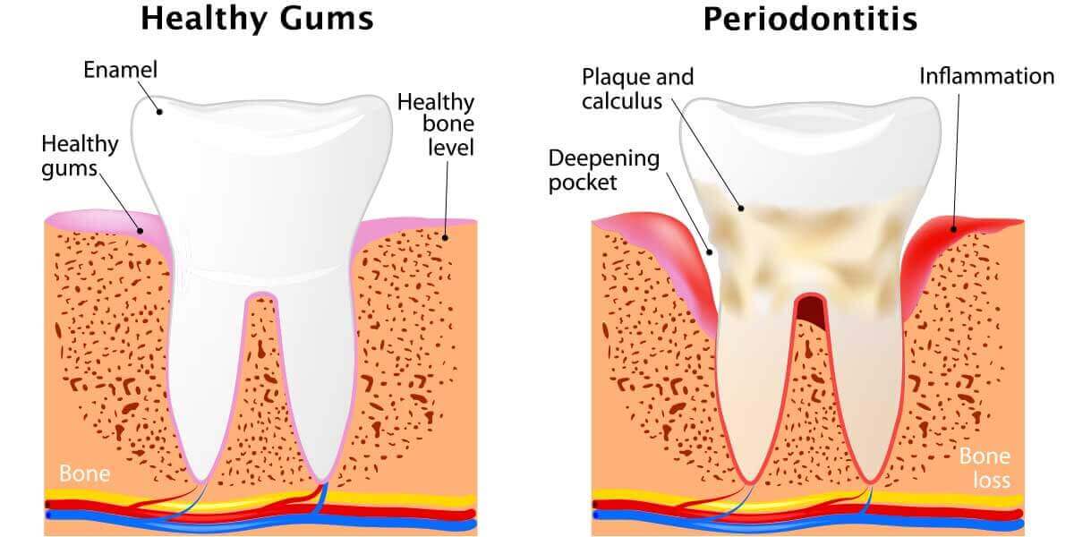 Stages of Periodontal Disease | Belmont Family Dentistry