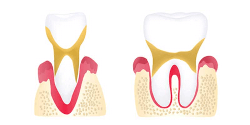 Advanced periodontitis illustration