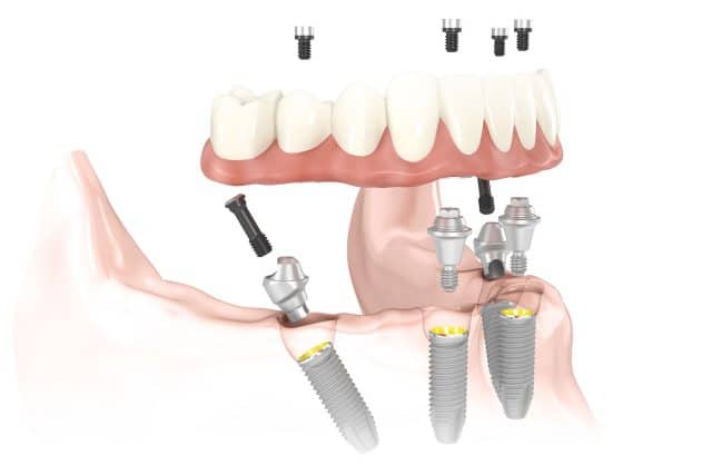 Full Arch with Only Four Implants graphic