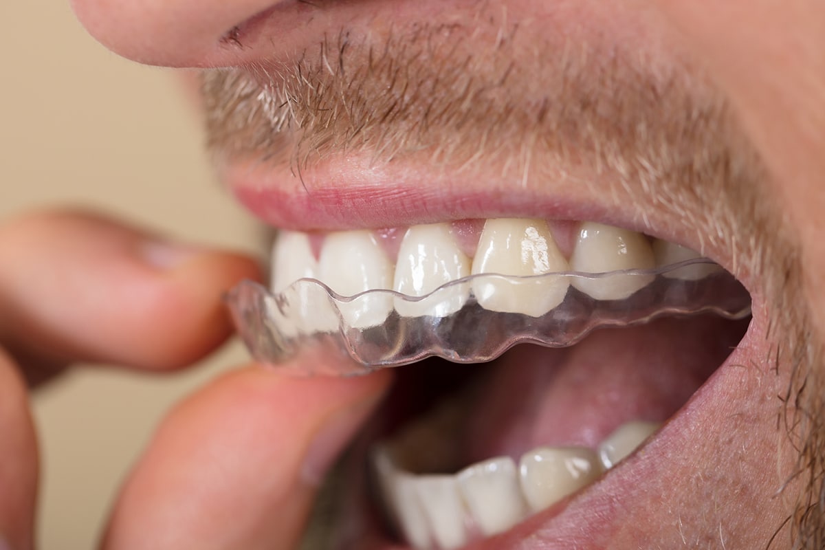 Can You Eat With Invisalign?