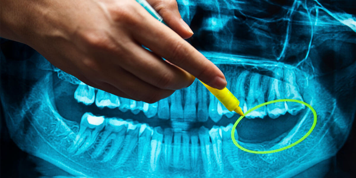 Dental Implants Benefits Image