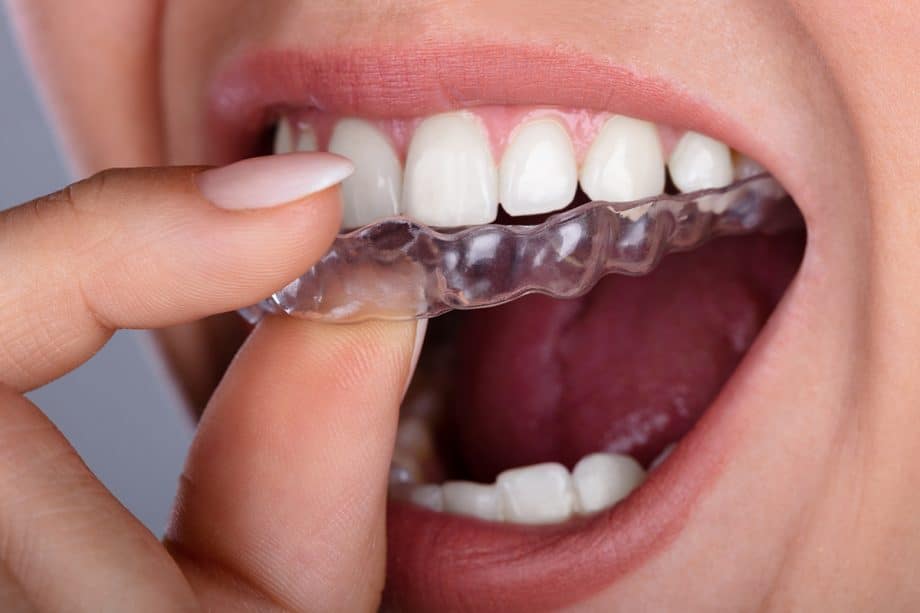 a woman inserts an Invisalign tray into her mouth